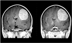 A new method of suicide gene therapy could lead to better treatment for human brain tumors, such as gliomas.