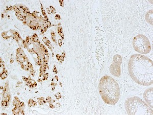 Fig. 1: Image of a human colon tumor section showing high PRL-3 protein in cancerous epithelia (left) but not in normal epithelia (right). The central section is a transition area.