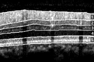 Fig. 1: Automatic segmentation of a spectral-domain OCT retinal image into five layers. The glaucoma can be diagnosed based on the thickness variation of the nerve fiber layer. 1, retinal nerve fiber layer; 2, ganglion cell layer; 3, inner plexiform/nuclear layer; 4, outer plexiform/nuclear layer; 5, photoreceptor layer.