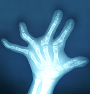 Hand X-ray showing the developmental abnormalities caused by TPBS