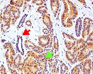 Microscopy image showing SPINK1 expression (brown) in breast tissue. SPINK1 is highly expressed in breast tumor tissue (green arrow) but not in adjacent normal breast tissue (red arrow).