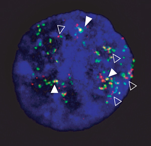 Interphase nucleus showing amplification and fusion of breakpoint flanking sequences. Double signals (filled arrowheads) indicate the fusion of the two loci and single signals indicate the normal genomic distance (open arrowheads).
