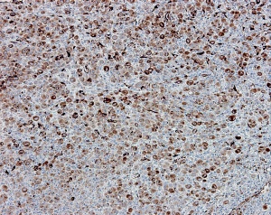 A microscopic image of melanoma tumor cells expressing SPARC