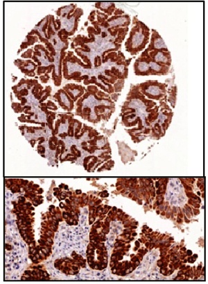 The immunostaining images highlight the parts where human primary lung cancer express glycine decarboxylase
