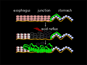 In the adult stomach (top), ’residual embryonic cells’ (green) are sequestered near the esophagus by mature epithelial cells (pink). Inflammatory damage caused by GERD (middle) disrupts this epithelial layer, and creates opportunities for a REC population to spread — forming a potentially precancerous growth (bottom).