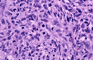 Undifferentiated malignant glioma cells in a cross-section of human brain tissue from the temporal lobe. 