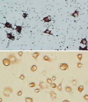Lipid droplets, labeled with the dye ‘Oil red O’, accumulate in normal macrophages exposed to oxidated LDL (top) as they transform into artery-damaging foam cells. However, macrophages that lack the gene encoding Wip1 (bottom) rapidly eliminate cholesterol and show little lipid accumulation.