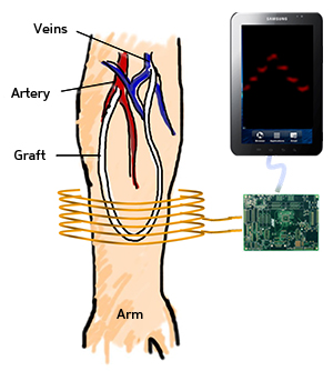 A handheld reader (top right) wirelessly powers and interrogates a tiny blood-pressure sensor embedded inside a prosthetic graft, inserted in this case as a conduit for haemodialysis in a patient with kidney failure.