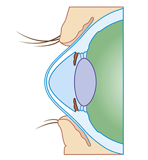 Keratoconus causes distortion of the cornea and can lead to blindness. Thin corneas are an indication of a risk of developing the disease.