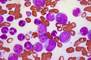 A smear of blood cells showing chronic myeloid leukemia cells in the stage known as ‘blast crisis’ (magenta).