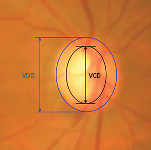 Using images of the optic disc in the eye, the cup-to-disc ratio (CDR) can be calculated by dividing the vertical cup diameter (VCD) by the vertical disc diameter (VDD).