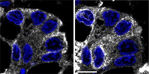 Cells from breast tumor biopsies show abnormally high accumulation of Tn-modified proteins in the endoplasmic reticulum (ER). Tn localizes to the ER in breast cancer cells (left, white), as indicated by labeling of the ER (right, white). Cell nuclei stained blue.