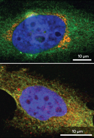 The location of GalNAc-T enzymes (red) and the endoplasmic reticulum (ER; green) in normal cells (top). When the signaling protein ERK8 is inhibited, GalNAc-Ts move from the Golgi to the ER (yellow staining; bottom).