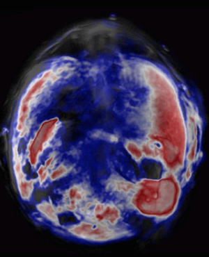A chemical probe that selectively and safely illuminates tumor cells can significantly boost the capabilities of an alternative bioimaging technique (red; concentration of probe one hour after injection).