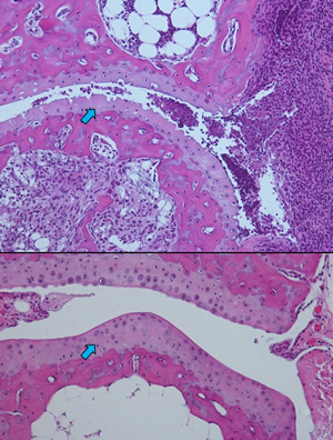 Joint tissue sections show that relative to untreated animals (top), treatment with the P2D7 antibody (bottom) greatly reduces cartilage loss (blue arrows).