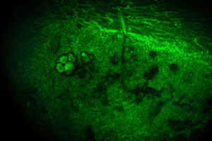 The introduction of polyoma virus small T proteins into human skin cells in culture (shown) was shown to increase the activity of Yes-associated protein (YAP), which is implicated in tumor formation.