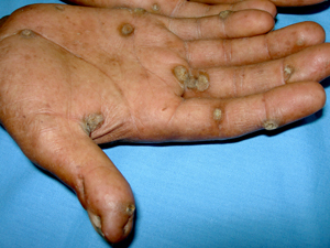 Multiple tumors known as keratoacanthomas on the palm of a Tunisian family member with an inherited disease.