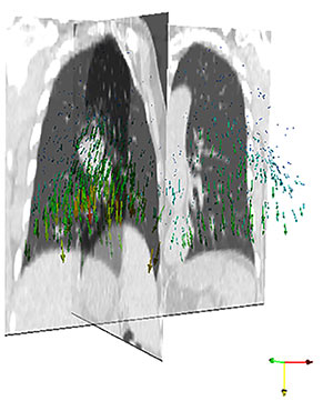 Image of lungs obtained by combining three-dimensional computed tomography and four-dimensional magnetic resonance imaging. It reveals both the interior three-dimensional structure of the lungs (including airways and tumors) and their motion (denoted by the colored arrows).