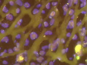 An osteosarcoma cells with TP53 broken into two segments, as indicated by the green labels on opposite sides of the nucleus.
