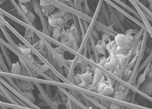 Glioblastoma cells growing along the fibers of the 3D scaffold.