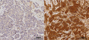 Primary (left) and recurrent (right) tumors images stained with p-IRAK1.