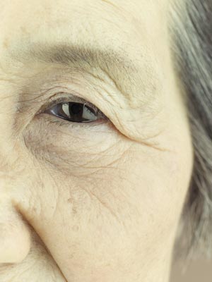 An A*STAR led team uncovered new genes associated with primary angle closure glaucoma.