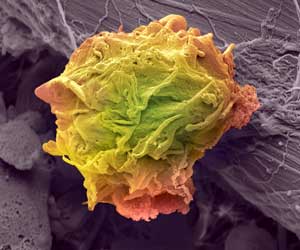 Malignant lymphoma cells attack the body instead of protecting it.
