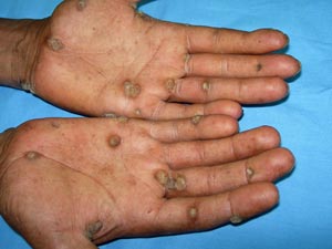 Typical symptoms of multiple self-healing palmoplantar carcinoma (MSPC) include lesions on the palms (as above) and feet.