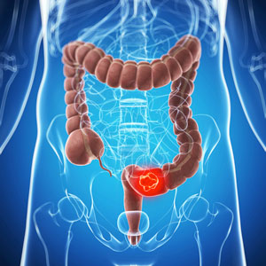 Bowel cancer (colorectal cancer) develops in the lower region of the gastrointestinal tract.