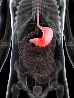 Researchers from A*STAR's Genome Institute of Singapore have discovered master regulatory elements in stomach cancer.