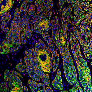Elevated expression of DIAPH1 protein (shown in red) in a squamous cell carcinoma patient.