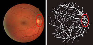 A retinal image (left) and the blood vessel network traced by the ‘absorbing random walk’ image processing algorithm.